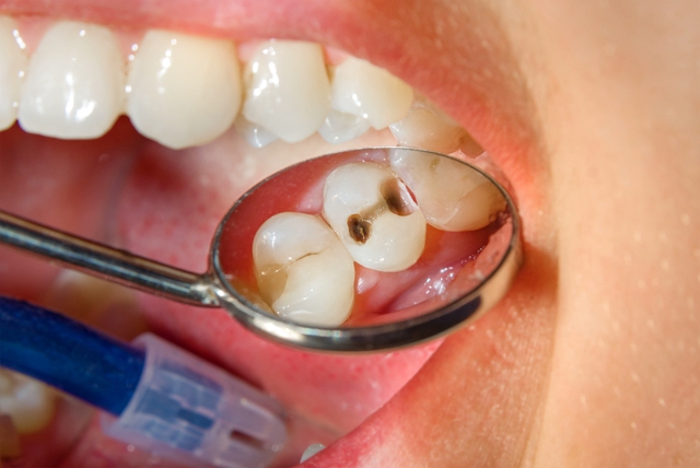 Dünyanın Üçte Biri,  Çürük Diş İle Yaşıyor